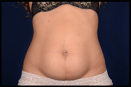 Extended Tummy Tuck After Pregancy