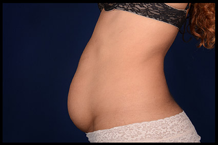 Post Pregnancy Extended Tummy Tuck