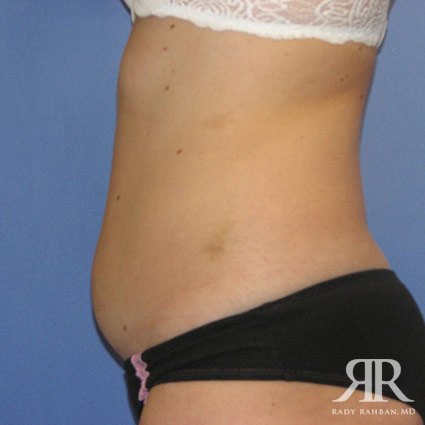 Liposuction Mommy Makeover